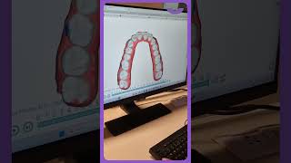 Whistle Aligners  Free Dental Scan amp Consultation from Orthodontist  Book Your Scan Today [upl. by Wilkins]