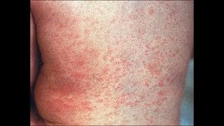 The causes and treatment of Roseola [upl. by Htiderem11]