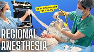 How anesthesiologists numb specific body parts actual video of a nerve block [upl. by Nevet]