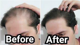 How I Grew Back my Hair with Rosemary Oil My Results w Pictures Before amp After  How To Use [upl. by Orren]