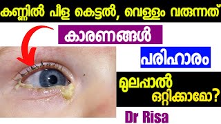 കുഞ്ഞിന്റെ കണ്ണിലെ പഴുപ്പ്Eye Discharge In Babies MalayalamHome remedy for Watery Eyes [upl. by Bithia176]