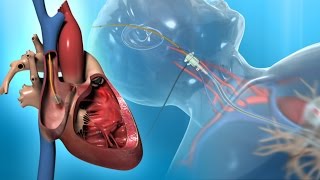 Right Heart Catheter for the Diagnosis of PAH [upl. by Tigdirb]