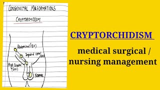 cryptorchidismmedical surgical topic nursing course [upl. by Hallock255]