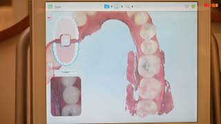 Orthodontic Records Itero Scanning for Clear Aligner Orthodontic Treatment [upl. by Dambro126]