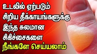 Some Best and Effective Home Remedies for Minor Burns [upl. by Lahcym]