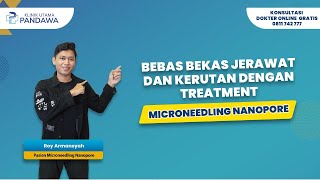 BEBAS BEKAS JERAWAT DAN KERUTAN DENGAN TREATMENT MICRONEEDLING NANOPORE [upl. by Aniham]