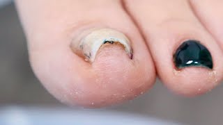 Toenail Fungus Cleaning at Home Success [upl. by Nessy]