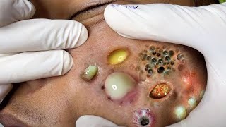 The Best Blackhead Cleaning Removal  Good Grooming Blackhead Removal 023 [upl. by Jezebel786]