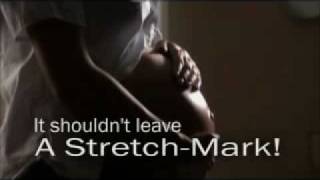 Stretch Marks After Pregnancy [upl. by Kobe]