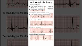 Atrioventricular block [upl. by Gillan]