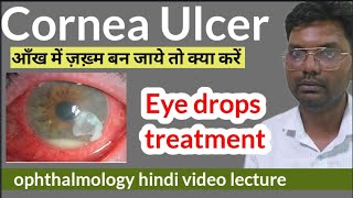 cornea ulcer treatment  cornea foreign body  corneal ulcer treatment  cornea ulcer eye drops [upl. by Elodie]