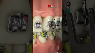 ¡TUTORIAL de como instalar BRACKETS metálicos en los DIENTES FRENILLOSBRACES [upl. by Jennifer]