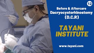 Before amp After DCR Dacryocystorhinostomy Surgery  Tayani Institute [upl. by Judith858]