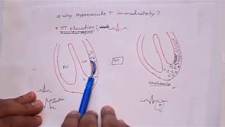 ECG 7  Myocardial infraction  ECG changes in MI and their mechanism [upl. by Clarabelle]