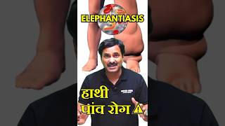 Elephantiasis Filariasis  हाथी पांव रोग 😰 disease neetpreparation neetexam [upl. by Debby186]