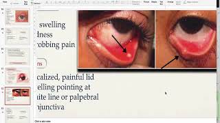 Hordeolum AND CHALAZION [upl. by Ebba]