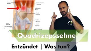 Quadrizepssehnenentzündung  Ursache amp Speziallösung [upl. by Bailie]