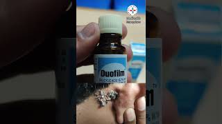 duofilm lotion for warts corn calluses [upl. by Aneelahs]