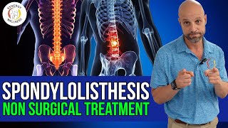 Spondylolisthesis Non Surgical Chiropractic Treatment [upl. by Maurey]