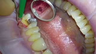 Dental Implant Placement [upl. by Supmart]