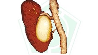 Ectasia pielocalicial Renal izquierda [upl. by Dibbrun878]