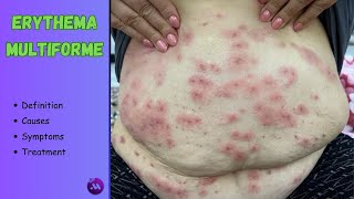 Erythema multiforme  Targetshaped lesions  All you need to know [upl. by Marcelia731]