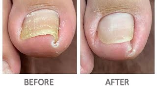 🩸✄ INGROWN TOENAIL Extraction [upl. by Margaret]