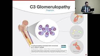 ACTUALIZACIÓN EN EL DIAGNÓSTICO Y MANEJO DE LA NEFROPATIA C3 [upl. by Harbison]