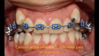 CASO ORTODONCIA MINIIMPLANTES DISTALIZACION MOLARES [upl. by Asilrac]