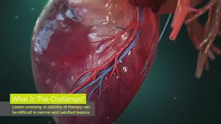 Coronary Artery Intervention  Dotter by Corindus 3D medical animation [upl. by Hubing]