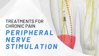 Peripheral Nerve Stimulation  What You Need To Know [upl. by Frida]