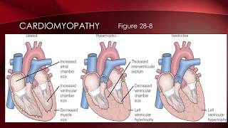 Perfusion Part 2 Cardiomyopathy Aneurysm and DIC [upl. by Renfred]