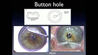 Refractive Course  04 LASIK FlapRelated Complications  Prof Yehia Salah [upl. by Larrad]