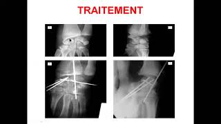 traumatologie [upl. by Emalia200]