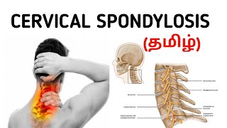 Cervical Spondylosis  Causes  Signs and Symptoms  Risk factor  Treatment  தமிழ் [upl. by Myke]