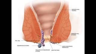 How Long Do Hemorrhoids Last With Preparation H  Hemorrhoid No More [upl. by Durrett]