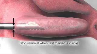 Turbinoplasty  Downtown Los Angeles  LA Sinus amp Allergy Specialists [upl. by Feinstein]