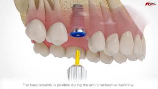 On1 restorative concept  Nobel Biocare [upl. by Anayet]