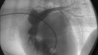 Pulmonic Stenosis Video [upl. by Korwun460]