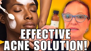 Hormonal Acne Eraser For Black Women [upl. by Radnaxela]