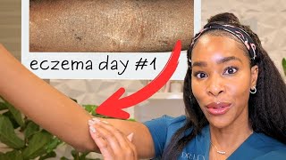 12 Life Changing Tips For Eczema From a Derm with Eczema [upl. by Barolet344]