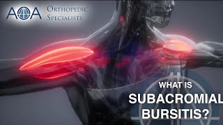 AOA Orthopedic Specialists  Subacromial Bursitis [upl. by Iram65]