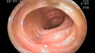 25042019 Aphthous Ulcers in Terminal Ileum Encountered During Colonoscopy [upl. by Nahpos]