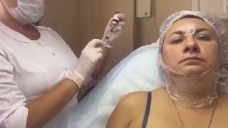 Kabelline live injection for double chin made by Russian clinic  Mediwith Korea [upl. by Joeann]