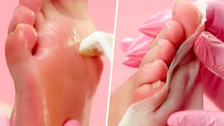 Extremely SATISFYING Calluspeeling  Foot Care [upl. by Anaibaf]