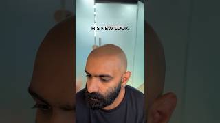 Scalp micropigmentation  New look ✅ scalpmicropigmentationindia scalpmicropigmentation smp [upl. by Jocelyn]