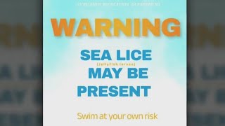 Rashcausing sea lice reported at NJ bay beaches [upl. by Andie862]