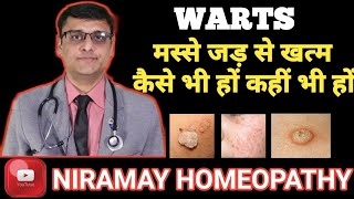 मस्से को जड़ से हटाने के उपाय  Home remedies for warts 100 effective [upl. by Ashlie]