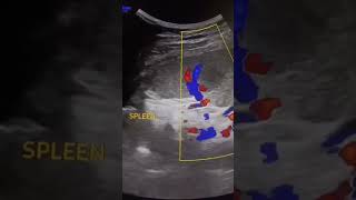 Splenic Abscess Ultrasound shorts videoshorts [upl. by Pontias]