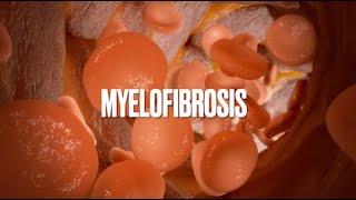 Understanding Agnogenic Myeloid MetaplasPrimary myelofibrosis PMFOsteomyelofibrosis bonemarrow [upl. by Thebazile854]